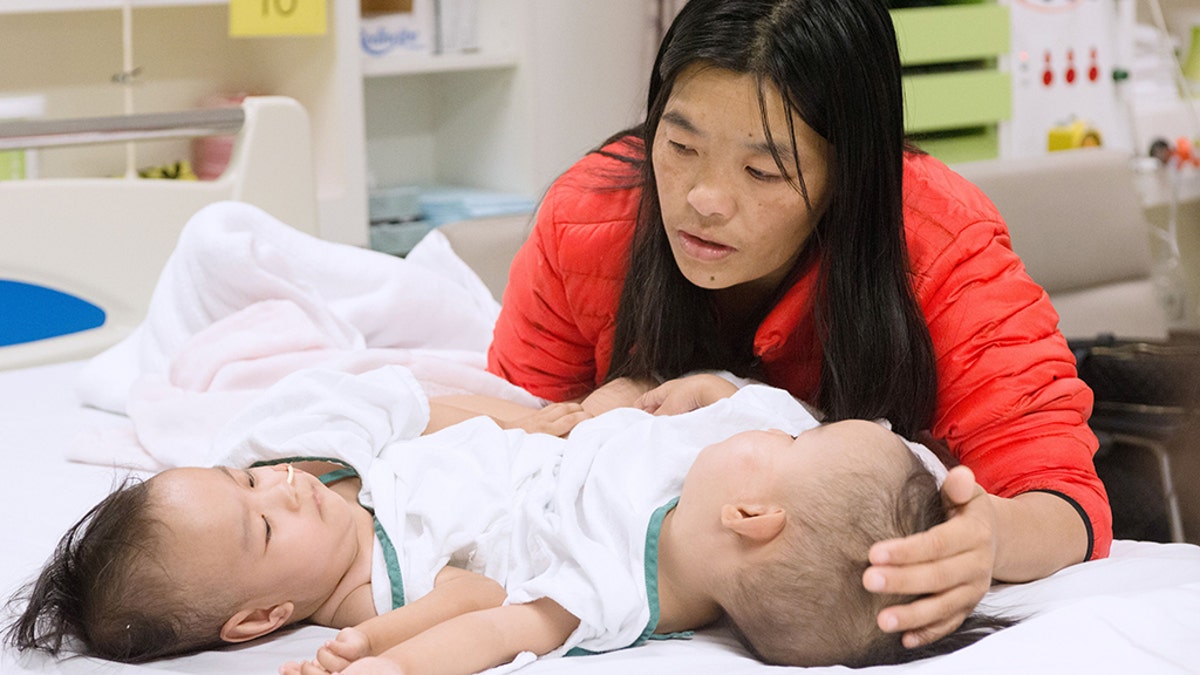 The girls, pictured with their mother before the surgery, are now breathing on their own.