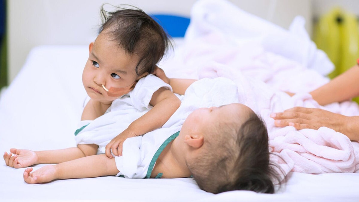 The girls, who were born attached at the torso, shared a liver.