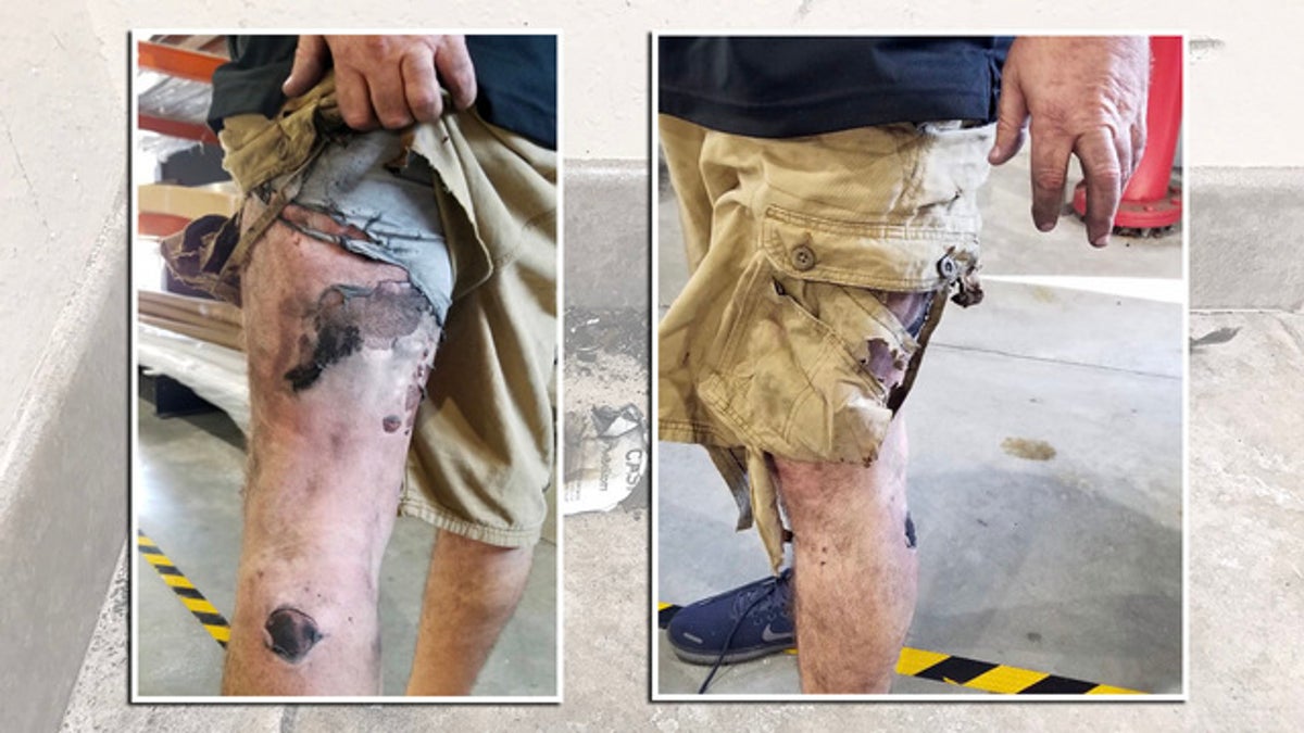 Man suffers third degree burns after vape pen explodes in pocket