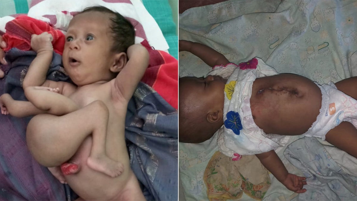 The baby, who was not identified by her surgeons, underwent a 2.5-hour surgery to have four extra limbs removed.