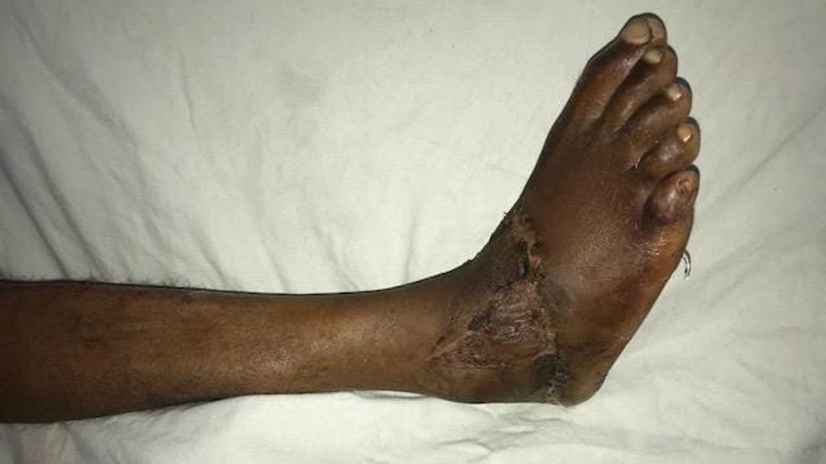The victim, a 27-year-old carpenter, needed a second operation to repair nerves and graft skin.