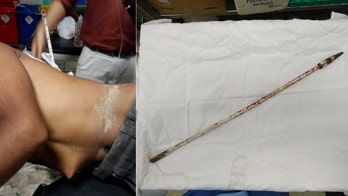 Doctors save biker impaled by metal rod