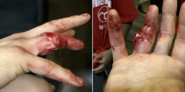 The gruesome photo shows Harvey Park's bone popping out of his finger.