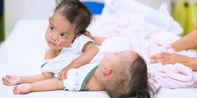 The girls, who were born attached at the torso, shared a liver.