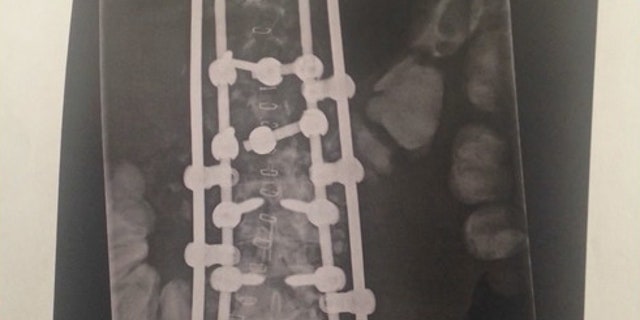 She suffered a spinal cord injury, collapsed lungs and other internal damage.