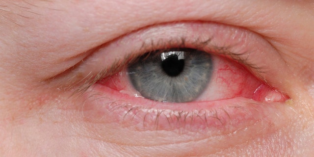A man in Italy was diagnosed with a rare condition that caused him to bleed from his eyes.