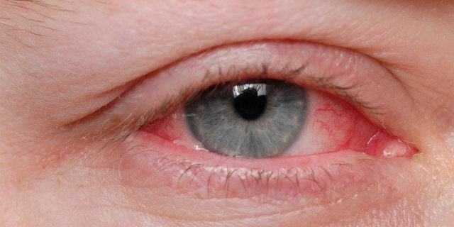 A man in Italy was diagnosed with a rare condition that caused him to bleed from his eyes.