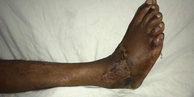 The victim, a 27-year-old carpenter, needed a second operation to repair nerves and graft skin.