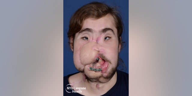 Underwood, pictured before the transplant, had been wearing a mask or bandanna in public to cover his injuries.