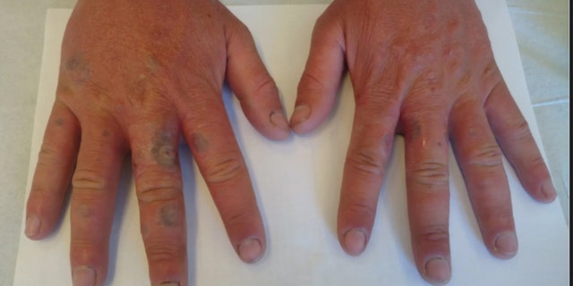 The doctors lanced and bandaged the man's blisters, gave him antibiotics to prevent bacterial infections and recommended that he wear gloves to protect his hands from the sunlight.