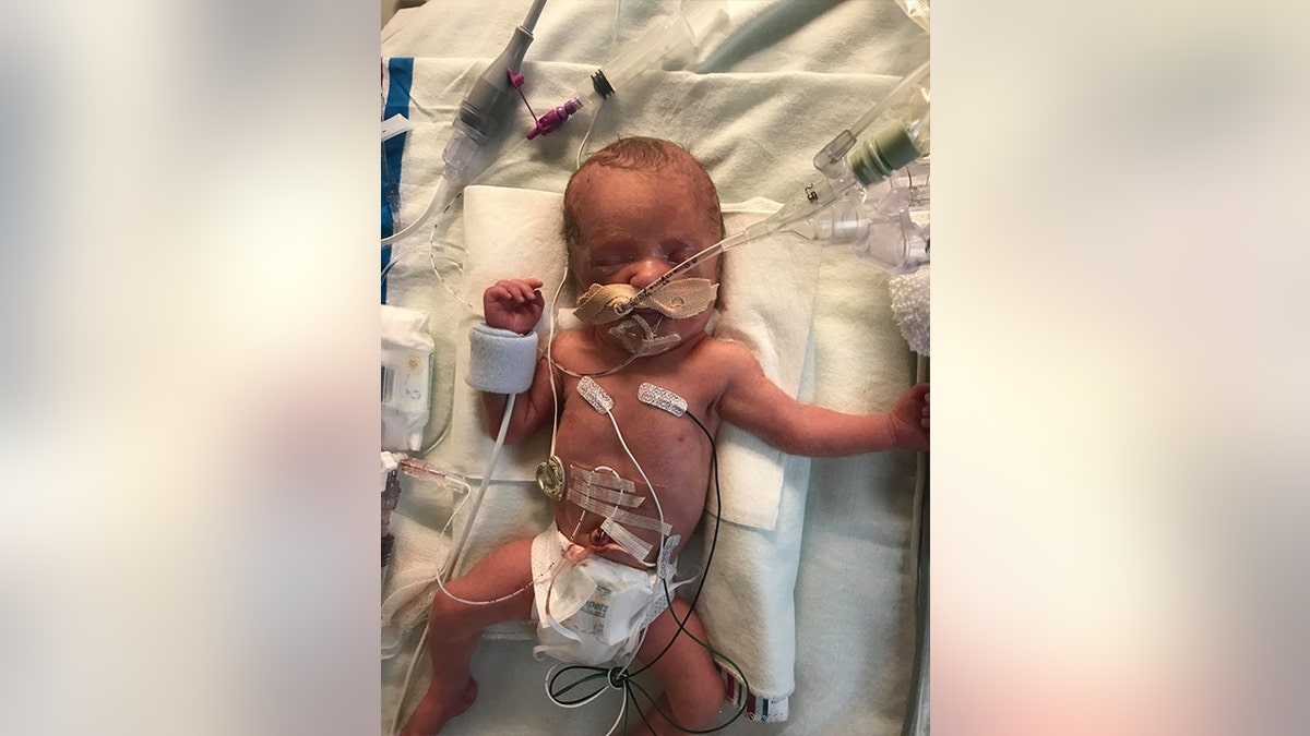 When the twins were born on January 13, Eva arrived in the world crying and breathing while Lucy [pictured] was blue and “very sick,” Zwick says, and the newborn was immediately placed on maximum support for her lungs.
