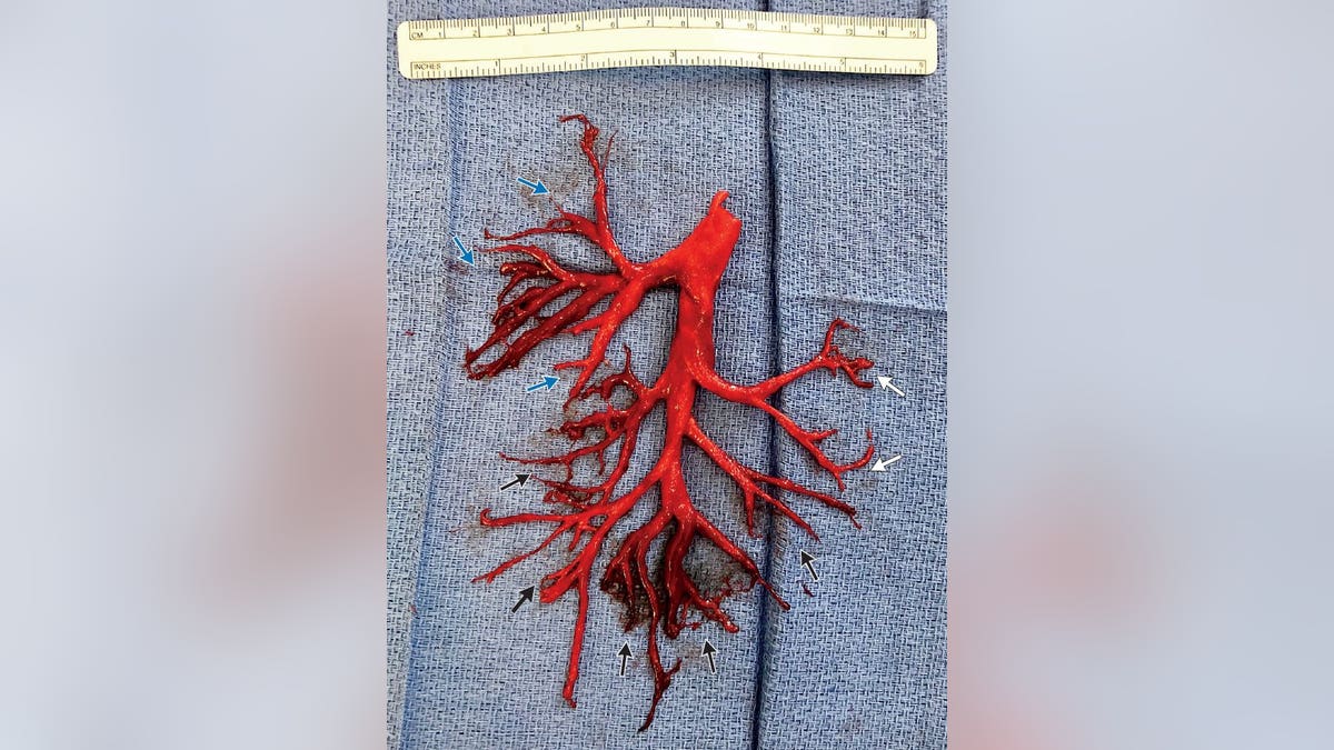 Patient coughs up blood clot in shape of lung passage: report