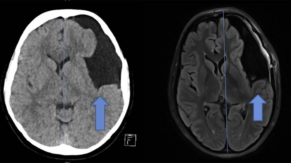 Above, images of the brain cyst before (left) and after (right) surgical treatment.