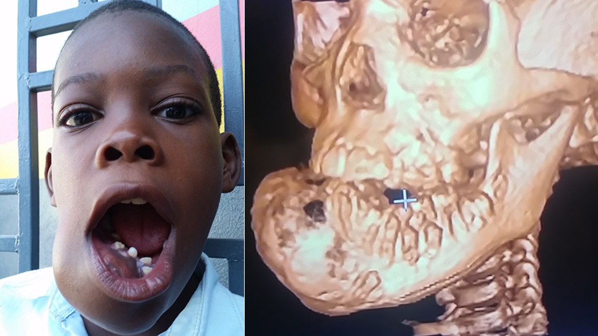 John "Little John" Olivier shows the tumor on his jaw that could not be treated in Haiti, but after a doctor in America agreed to do it pro bono, he got the life-saving surgery in November.