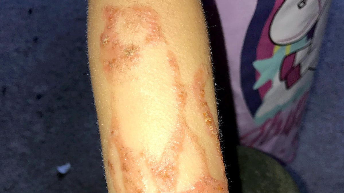 Doctors diagnosed her with a chemical burn, and she was put on antibiotics for 10 days.