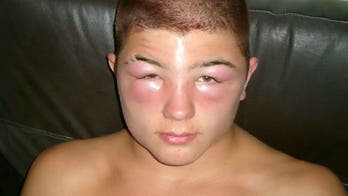 Man's eyes, neck swell in bizarre reaction to hair dye