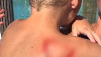 Increase in accidental burns seen for kids at home during pandemic