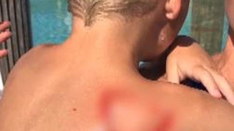 Increase in accidental burns seen for kids at home during pandemic