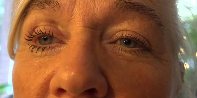 The Belgian woman was recently fitted for a prosthetic eye.