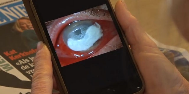 Petra van Kalmthout shows a picture of her eye infected with the parasite. (CEN)