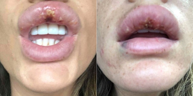 Knappier said she had previously received Botox at a clinic, and thought the injection would be safe.