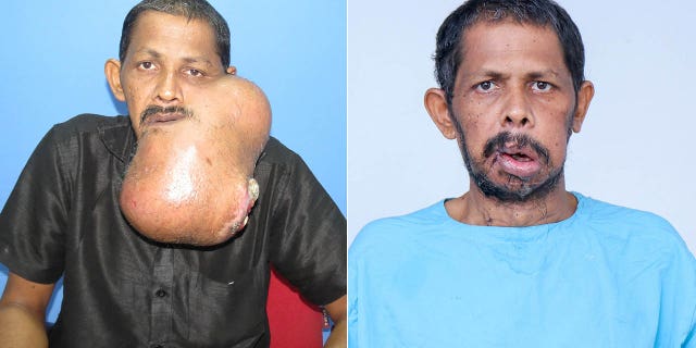Majeed N, 45, from India, underwent a painstaking 12-hour facelift surgery to have the cancerous lump cut out.