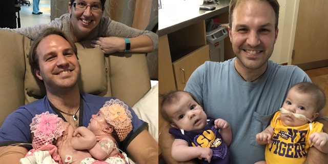 Formerly Conjoined Twins Head Home After 7 Surgeries Fox News Formerly Conjoined Twins Head Home After 7 Surgeries Fox News