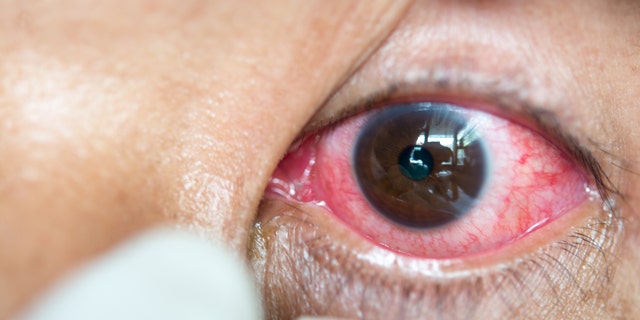 red bloodshot eye