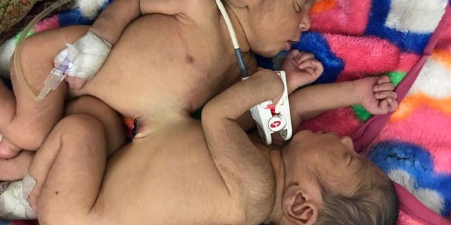 The girls, pictured before the surgery, were only 3 days old at the time of the operation.
