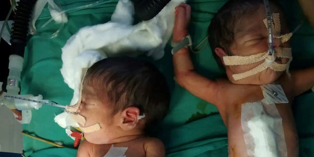 Surgeons Separate 3 Day Old Conjoined Twins In 5 Hour Operation Fox News