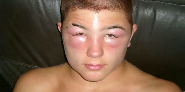 Man's eyes, neck swell in bizarre reaction to hair dye | Fox News