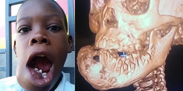 John "Little John" Olivier shows the tumor on his jaw that could not be treated in Haiti, but after a doctor in America agreed to do it pro bono, he got the life-saving surgery in November.