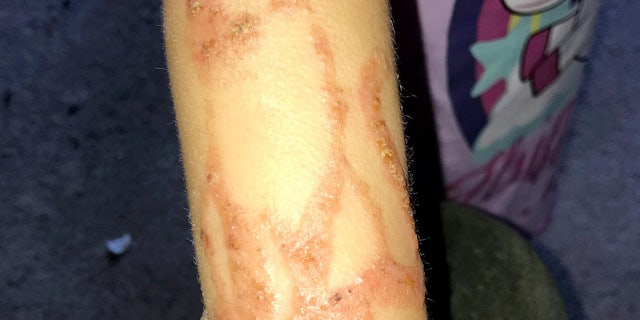 Doctors diagnosed her with a chemical burn, and she was put on antibiotics for 10 days.