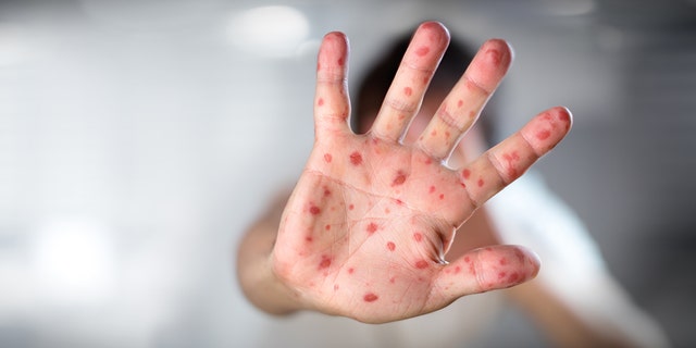 An individual who flew to a New Jersey airport on Christmas Eve has a confirmed case of the measles, health officials said Friday, while warning that others could’ve potentially been exposed.