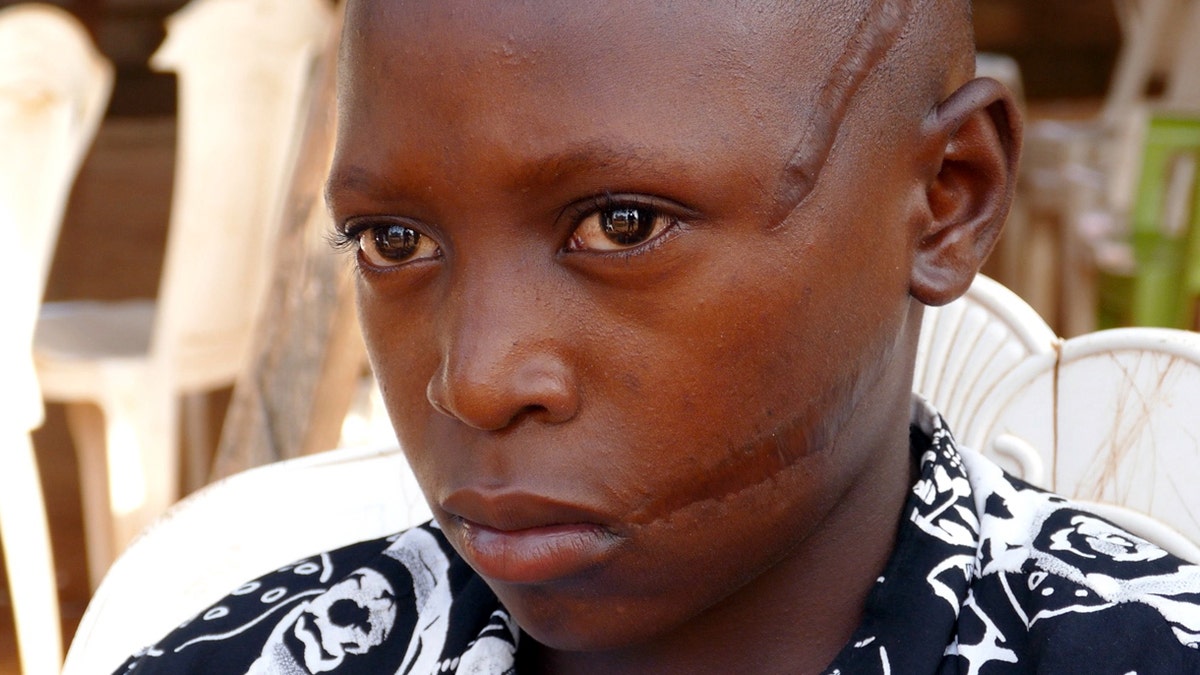 Abednego Solomon was 10 years-old when he was slashed by Fulani militants who attacked his village in Nigera.