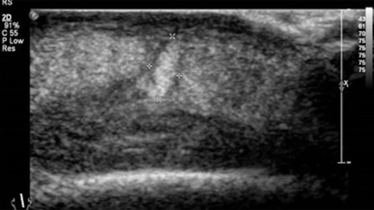 An ultrasound revealed a second fly still burrowed inside the woman's head.