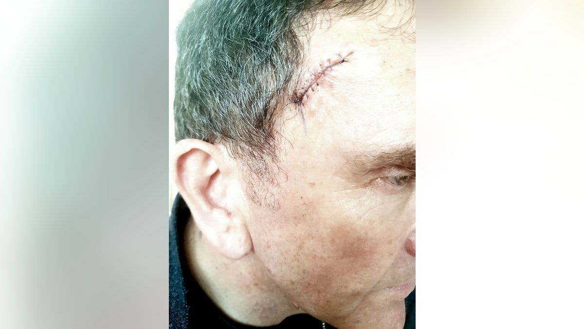 Adam Shatford had multiple cancerous growths removed from his face and forehead after his hairdresser encouraged him to get them checked by a doctor.