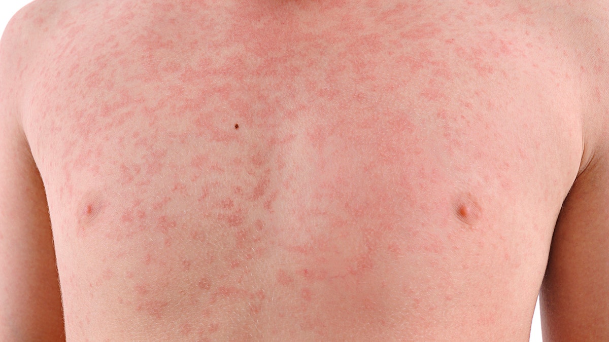 Measles symptoms begin with a fever, cough, runny nose and red eyes, are are followed by a rash.