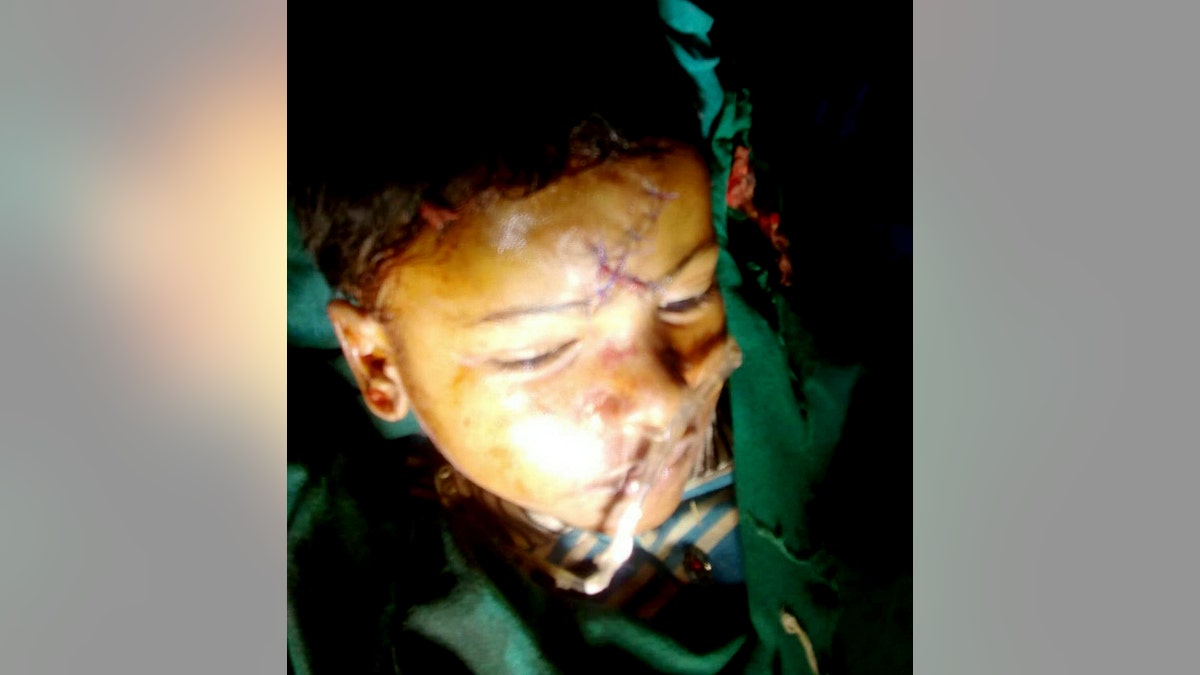 It took 90 minutes for surgeons to remove the bolt from 5-year-old Chhabila Kumar's head.