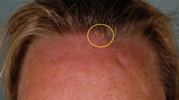 Woman finds baby flies living in forehead after trip to Uganda