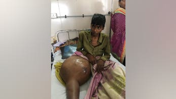 Teen's entire leg amputated to remove 55-pound tumor