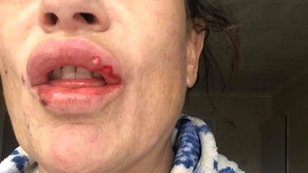 Mom's lips left oozing pus after low-cost fillers