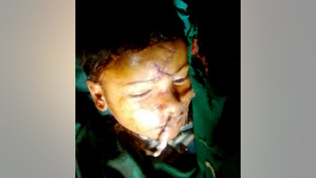 Boy survives horrific injury after bolt pierces skull