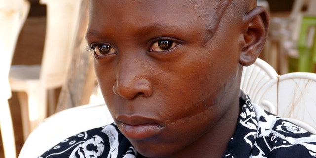 Abednego Solomon was 10 years-old when he was slashed by Fulani militants who attacked his village in Nigera.
