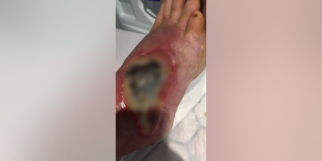 Blurton said that he could feel the maggots eating away at the infection.