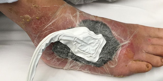 The infection left Blurton with an indent in his foot, and he said he has not had feeling in the area since the procedure.