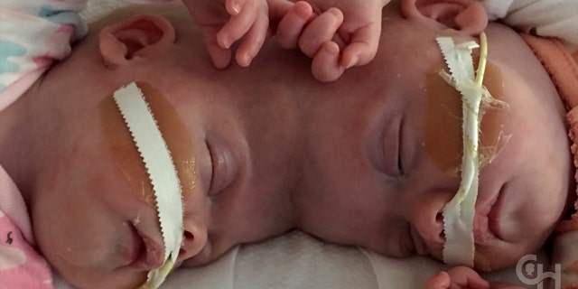 The girls face an additional surgery in their future for an implant to repair the opening in their skulls created by the separation procedure.