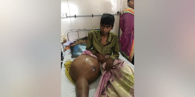 These astonishing images show a teenager who his leg removed to get rid of a massive tumor.