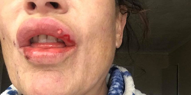 Tracy Bates said she noticed her lips were more swollen than usual, and shortly after recognized an infection and tried to squeeze the filler out.