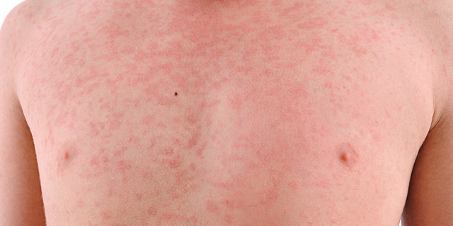 Measles cases confirmed in Washington and Oregon by health officials ...